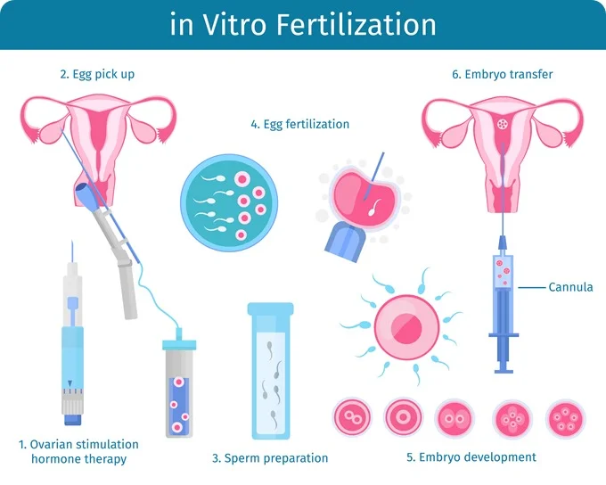 ivf egg retrieval